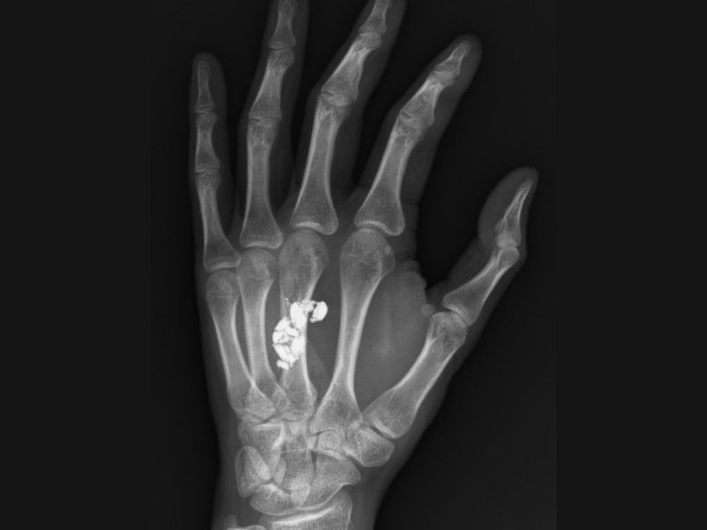 Radiografía de la mano izquierda. Se aprecia un perdigón desintegrado justo al centro, a la altura del tercer metacarpiano.